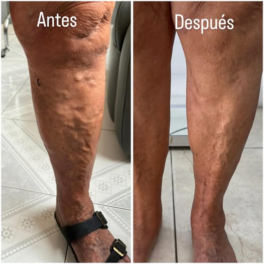 Alivra™ Calcetas de Compresión para Descansar tus Piernas