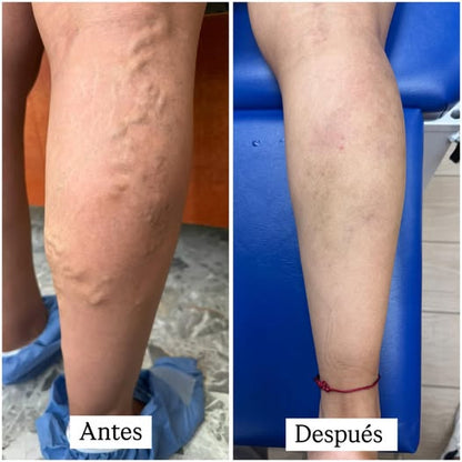 Alivra™ Calcetas de Compresión para Descansar tus Piernas