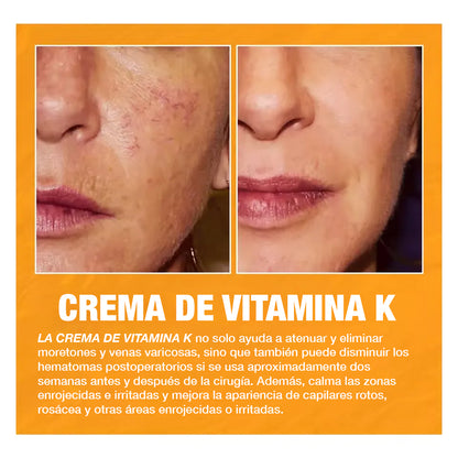 Eelhoe™ Crema quita venitas al instante - con Vitamina K