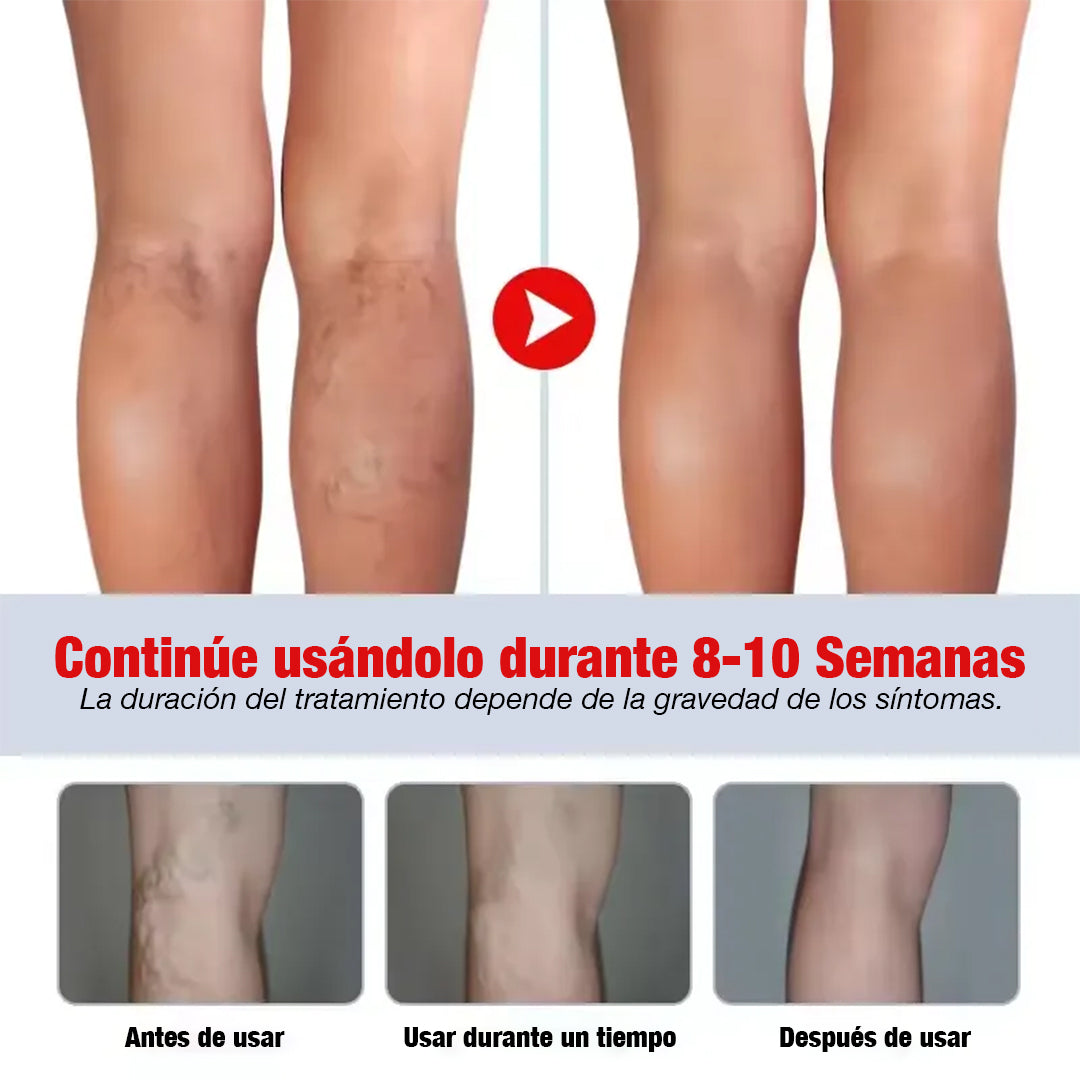 Kanye HB™ Adiós Varices, rápido y natural - Pomada Herbal