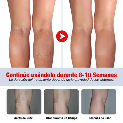 Kanye HB™ Adiós Varices, rápido y natural - Pomada Herbal